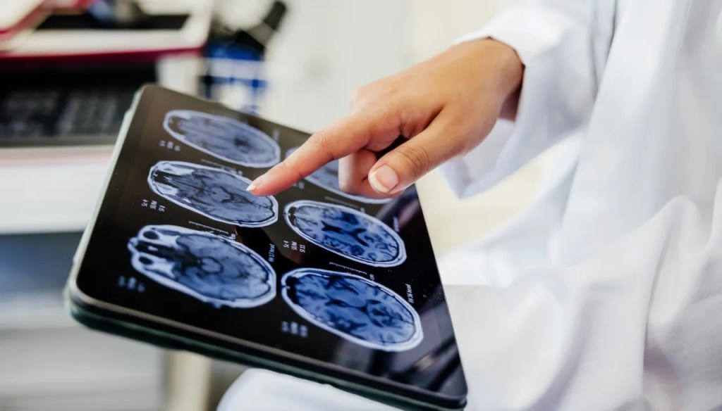 Breakthrough New Huntington’s Treatment Reduces Disease Progression by 75&nbsp;Percent