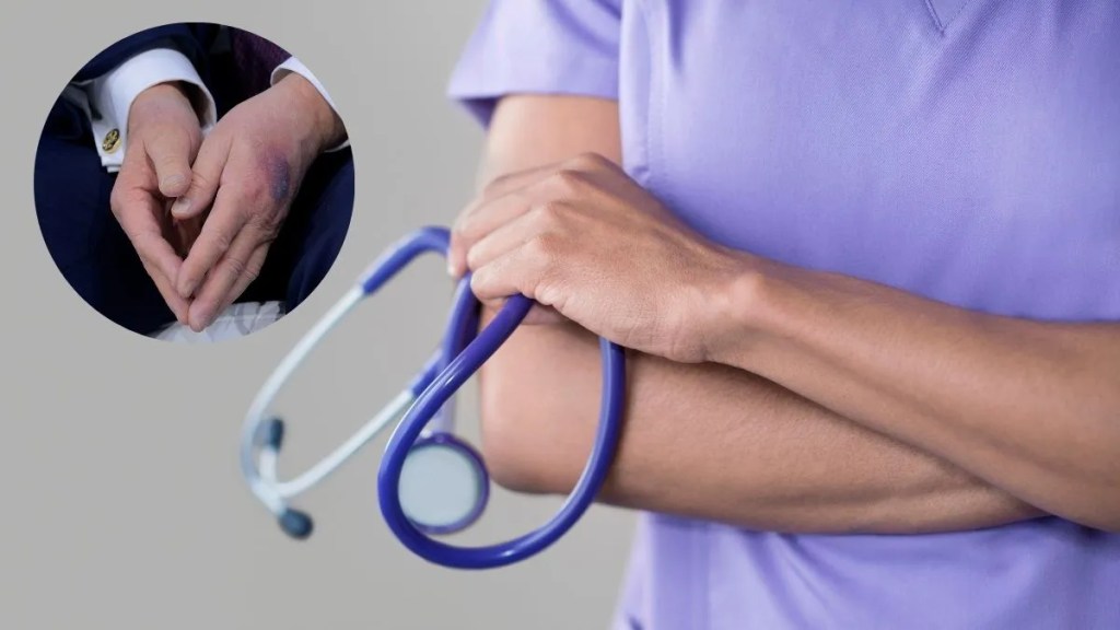 Discover Why President Trump’s Hand Is Bruised—Doctor Explains Causes and&nbsp;Cures